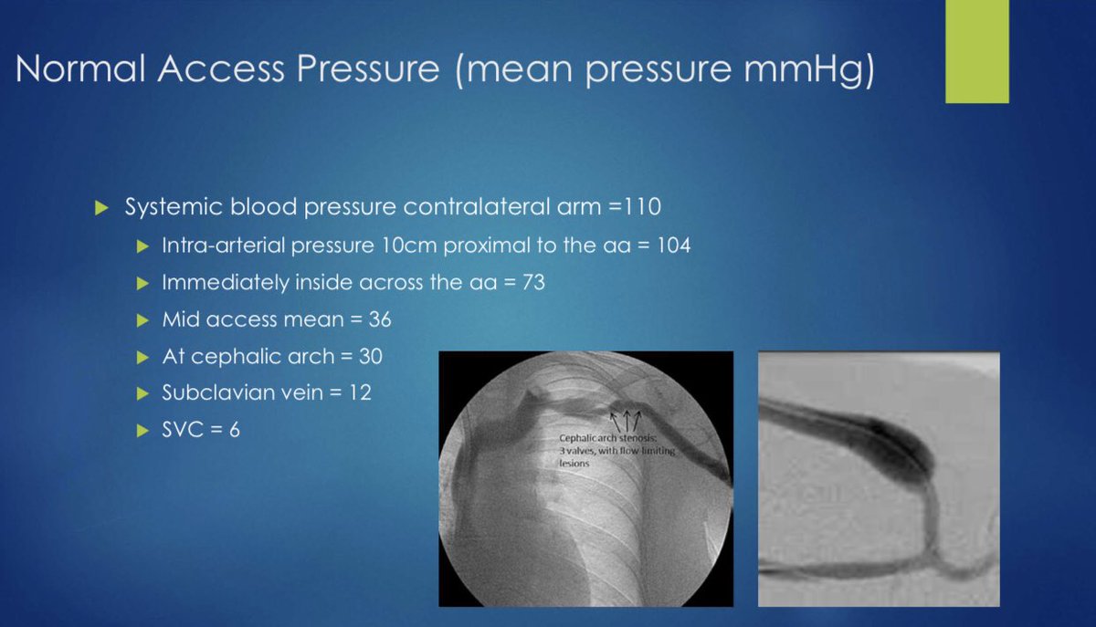edgarvlermamd's tweet photo. On hemodialysis access flows
#ASDIN2020 #Nephpearls https://t.co/qidi2ZUENO