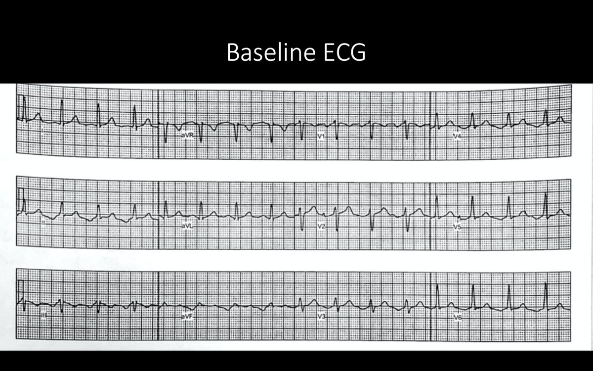 FrischMd's tweet image. Rare site for tachy-med. cardiomyopathy (TCM) but common site for abl (annular CTI). Good article: TCM in 10% of AT pts. “A slower incessant tachycardia is more frequently complicated by [CM].” (Medi, Kistler et al. JACC 2009;53:1791) @peterkistler3 @JoshSellke #mapmoreburnless
