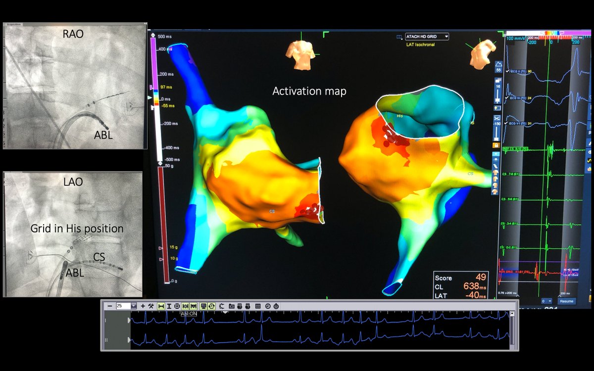FrischMd's tweet image. Rare site for tachy-med. cardiomyopathy (TCM) but common site for abl (annular CTI). Good article: TCM in 10% of AT pts. “A slower incessant tachycardia is more frequently complicated by [CM].” (Medi, Kistler et al. JACC 2009;53:1791) @peterkistler3 @JoshSellke #mapmoreburnless