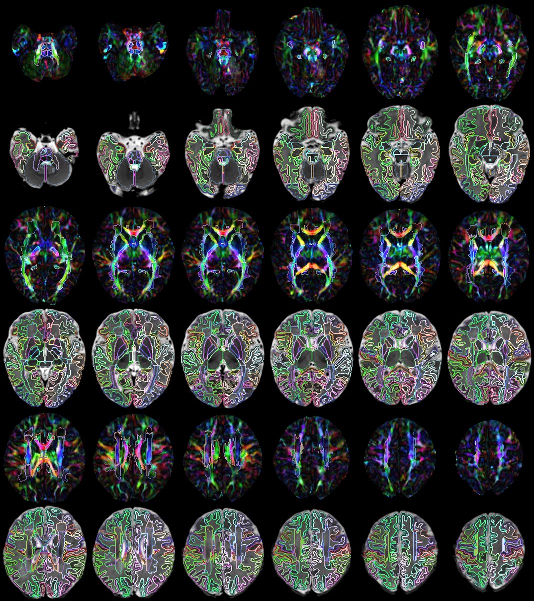 Our M-CRIB-WM neonatal parcellated white matter atlas has just been published: onlinelibrary.wiley.com/doi/full/10.10…, and the ten individual parcellated datasets are publicly available here: osf.io/mnwv9/
