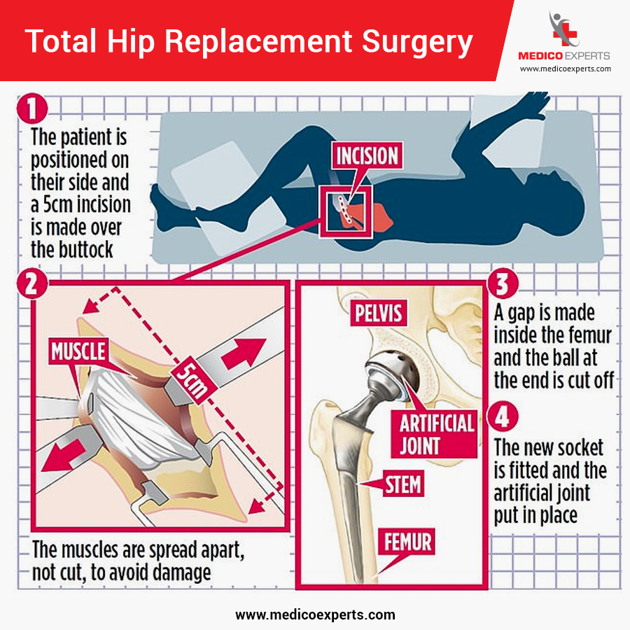 Total Hip replacement surgery For more details visit us at. pic.twitter.com...