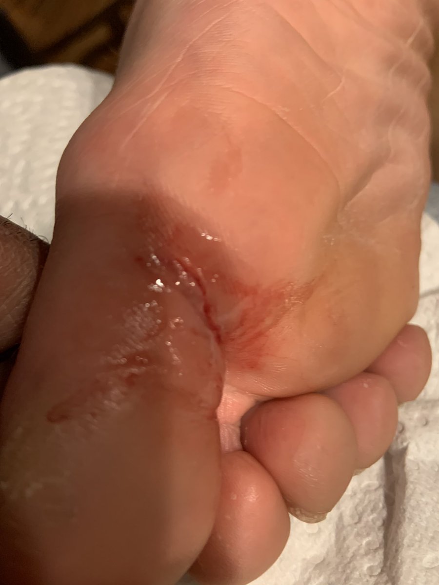 FMS_CoachLaDay's tweet photo. My 15 yr. old son is a LJ put out a PR of 20โ5โ a weeks ago Sunday & 19โ7โ yesterday. But slipped running up the stairs and is out for a few weeks. Shoot!! Split his big toe open @ ER until 1 am getting it stitched up. Praying for a quick recovery #LaDayracing #FMSprintCoach https://t.co/Q4bPTghMCl