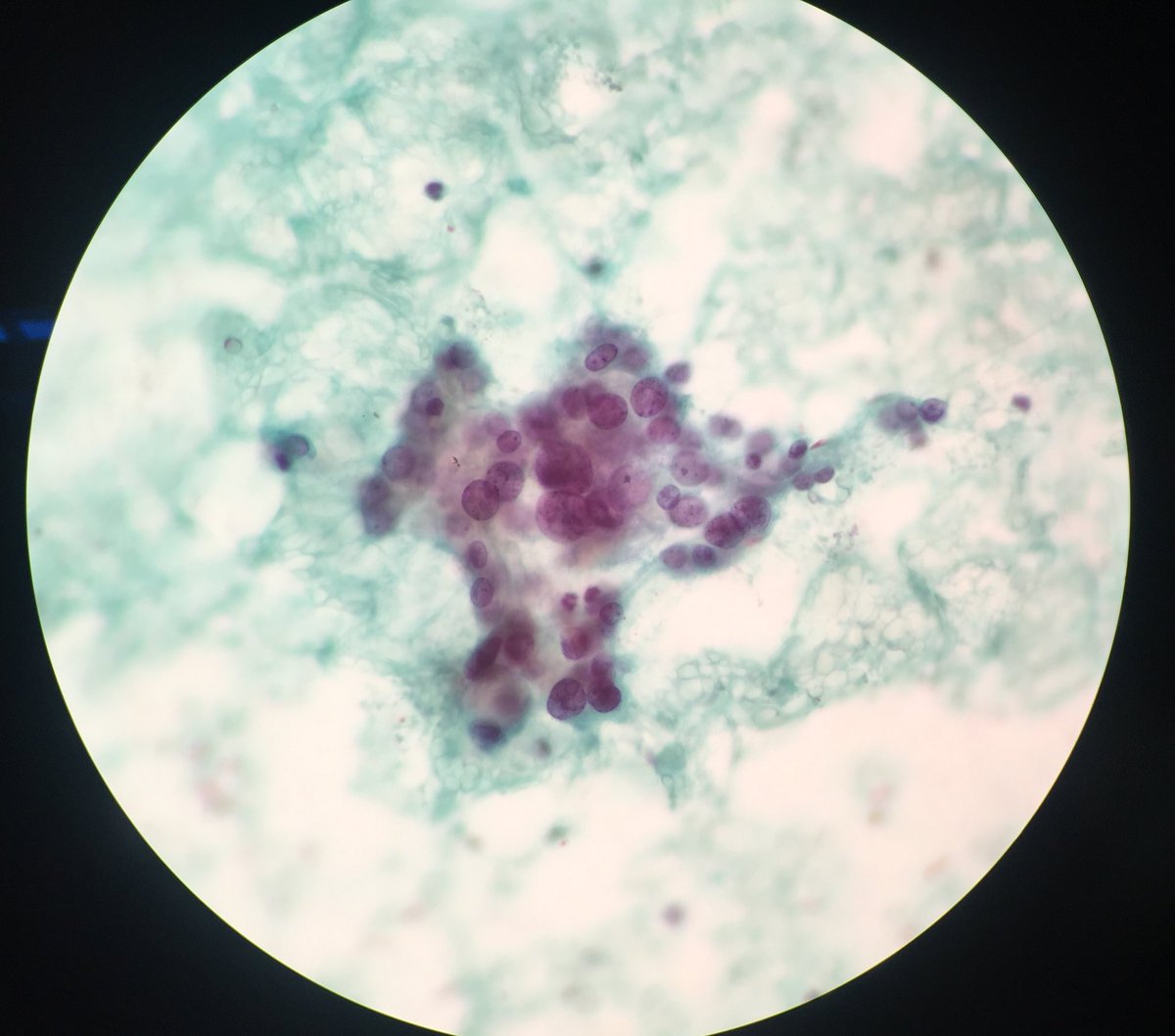 TCytologist's tweet photo. Case on working today.Female 48yrs. FNA Mass at neck.💉💉 🔬🔬🦠🦠 #cytology  #papstain #cytopatho #cytopath  #cytotechnologist #cytologists https://t.co/mioF93ZlgU