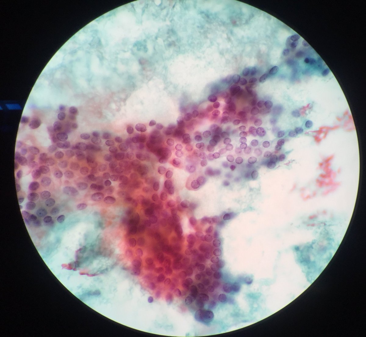 TCytologist's tweet photo. Case on working today.Female 48yrs. FNA Mass at neck.💉💉 🔬🔬🦠🦠 #cytology  #papstain #cytopatho #cytopath  #cytotechnologist #cytologists https://t.co/mioF93ZlgU
