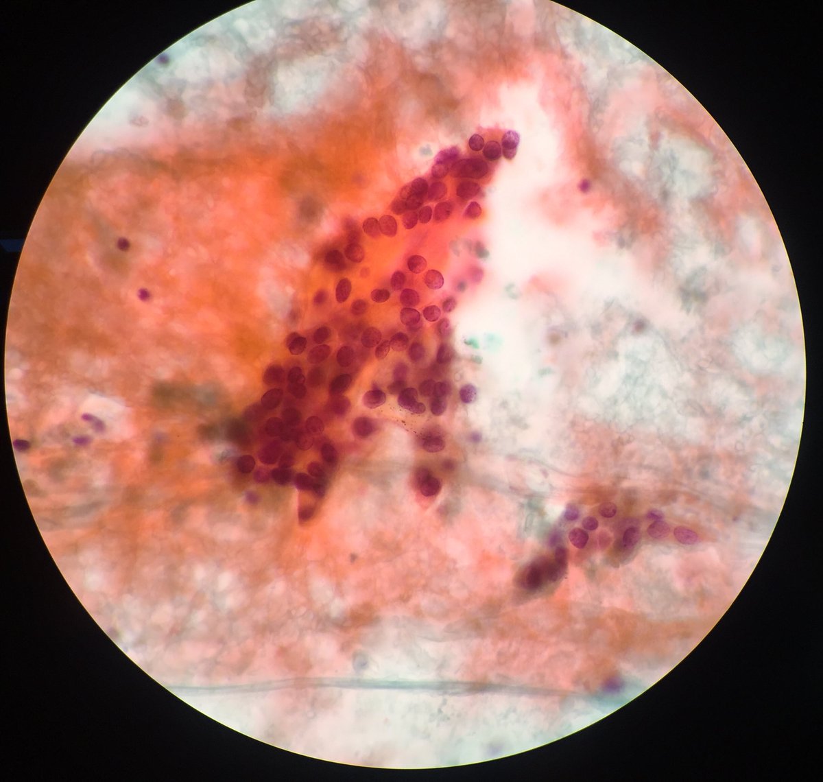 TCytologist's tweet photo. Case on working today.Female 48yrs. FNA Mass at neck.💉💉 🔬🔬🦠🦠 #cytology  #papstain #cytopatho #cytopath  #cytotechnologist #cytologists https://t.co/mioF93ZlgU