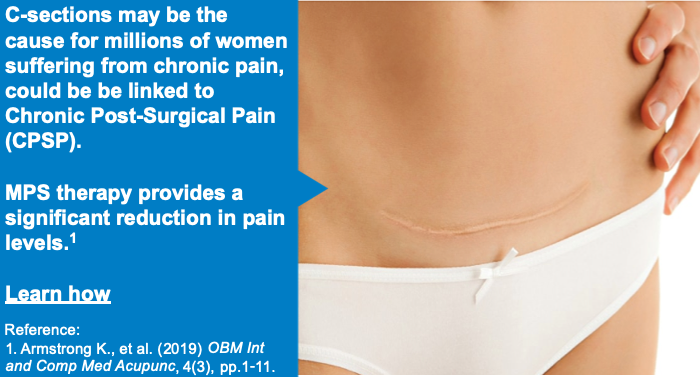 PainExpertKelly's tweet photo. C-sections may be the cause for millions of women suffering from chronic pain and could be linked to Chronic Post-Surgical Pain (CPSP).
MPS therapy provides a significant reduction in pain levels.
Learn how:
https://t.co/eezAQ0PUcY
#DolphinMPS #PainRelief #CSection #ScarPain https://t.co/gL5knNIbEl
