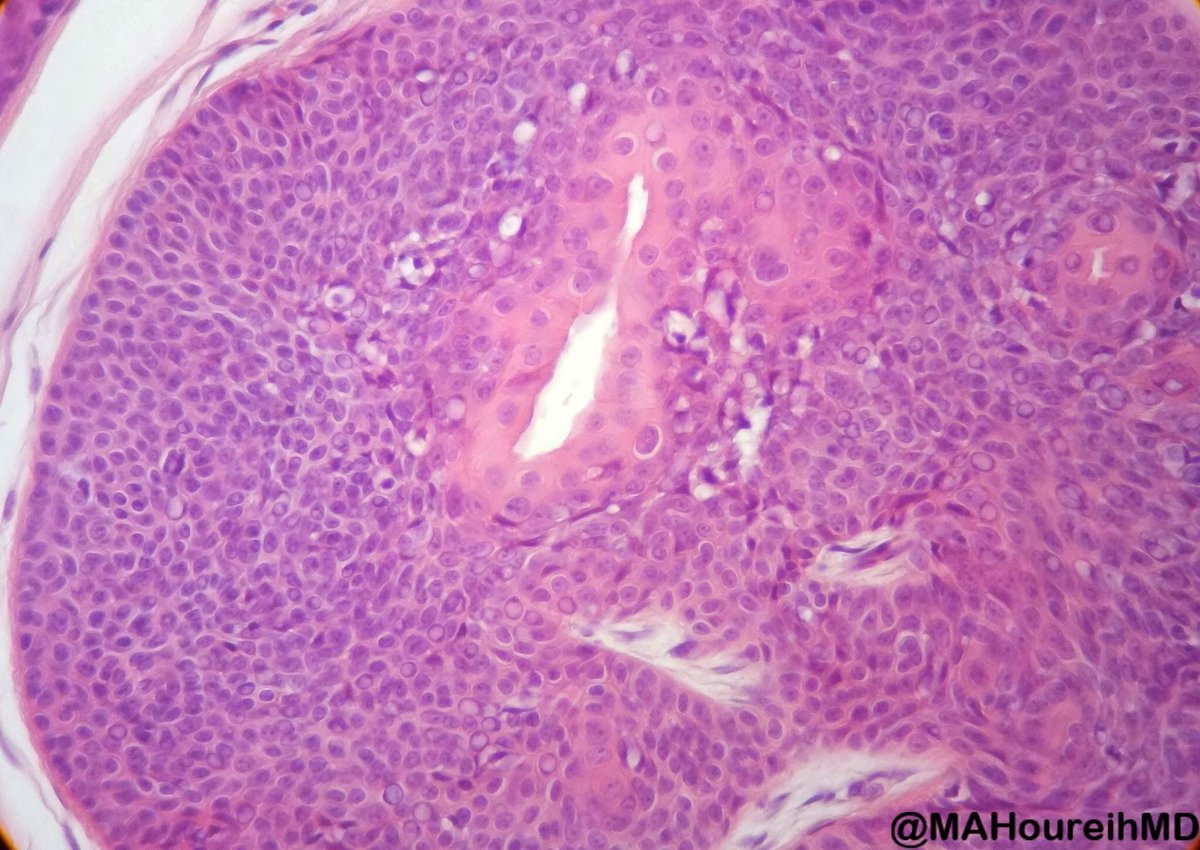 Jerad Gardner, MD (@jmgardnermd) on Twitter photo Nodular & Cystic Hidradenoma. Uniform bland cells. Ducts. Beautiful pics by @MAHoureihMD. Learn practical approach to skin adnexal tumors in our paper in <a href="/ArchivesPath/">Arch Pathol Lab Med</a>: buff.ly/2Hunw4p <a href="/EHFultonMD/">Edward Fulton, MD</a> <a href="/JRKaley/">Jennifer Kaley</a> #Pathology #dermpath #dermatology #grosspath #dermtwitter Nodular & Cystic Hidradenoma. Uniform bland cells. Ducts. Beautiful pics by @MAHoureihMD. Learn practical approach to skin adnexal tumors in our paper in <a href="/ArchivesPath/">Arch Pathol Lab Med</a>: buff.ly/2Hunw4p <a href="/EHFultonMD/">Edward Fulton, MD</a> <a href="/JRKaley/">Jennifer Kaley</a> #Pathology #dermpath #dermatology #grosspath #dermtwitter