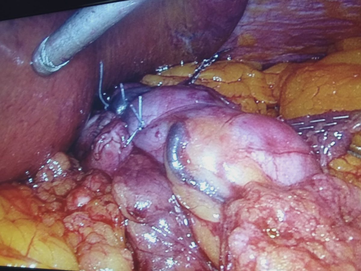 jftrebolle's tweet photo. Varón de 53 años.....IMC 38 + HTA + DM 2 con buen control con Metformina + Párkinson con LevoDopa. Gastroscopia con Esofagitis grado B......un buen caso para Sleeve-Nissen @MValeroS2 @JLBlasLaina @secojoven @aec_obesidad #SoMe4Surgery #cirugiahrv https://t.co/5XgJWIGIeI