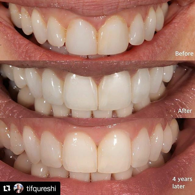 Patience is key 👏 some great looking results 
#Repost <a href="/tifqureshi/">tifqureshi</a>
・・・
UNDOING DENTISTRY Nearly 4 year review  on this case and looking stable (but not perfect - but that can be a GOOD thing) - SWIPE Right to see Ortho steps ◽️◽️◽️◽️◽️◽️◽️◽️◽️◽️◽️◽️◽️… ift.tt/2HSh9Io