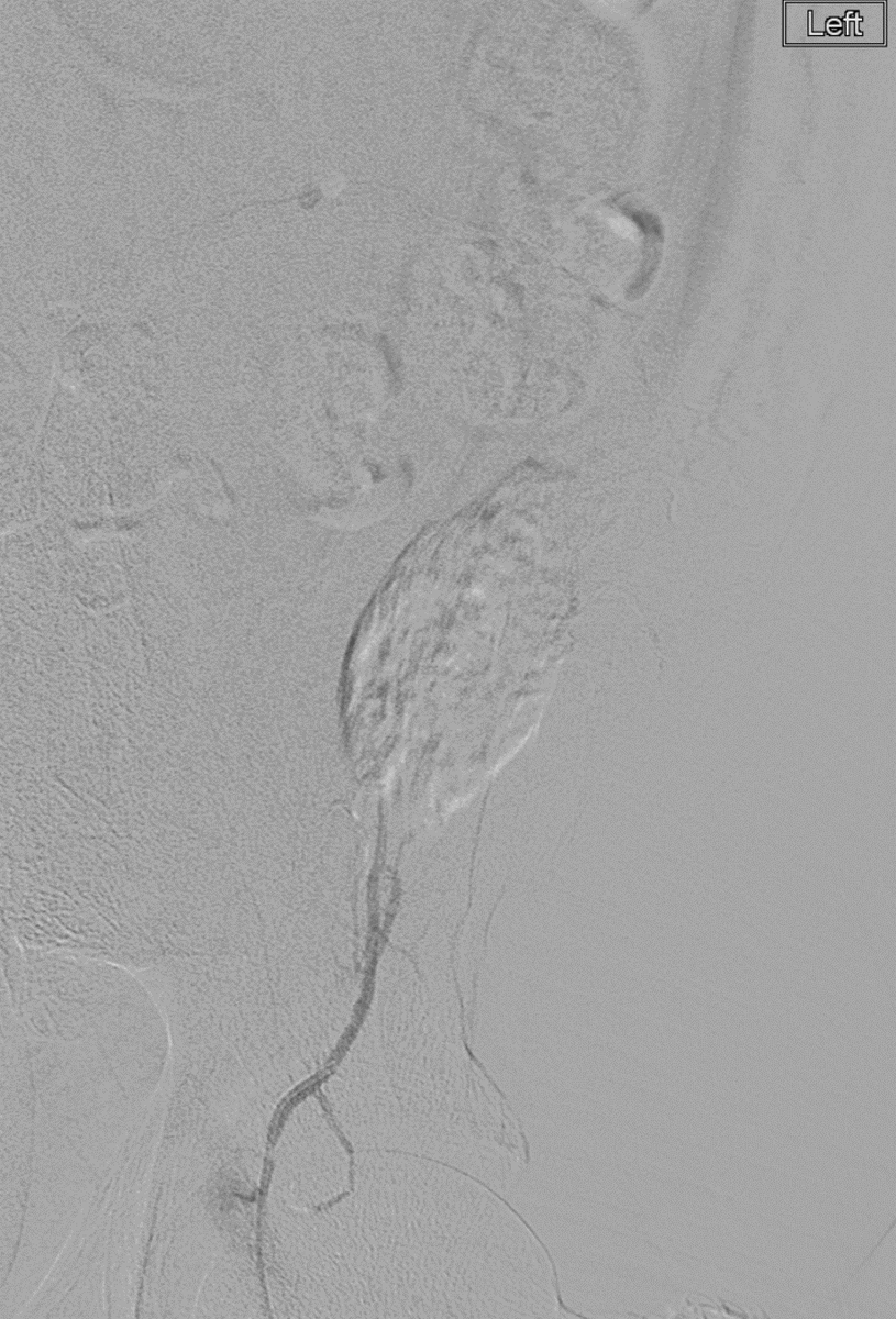75 yo on Eliquis, w/ acute intense abdominal pain found to have a spontaneous rectus sheath hematoma. Angio w/ inferior epigastric extrav -&gt; glue #embolization. 

#StopTheBleed
#TwittIR #Interventional #Radiology #Irad #IROnCall #IRadRes #MIIP #WithoutAScalpel #InnovationToHeal