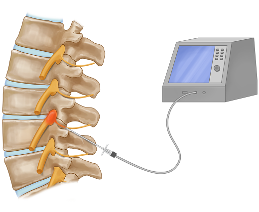 FNeirami's tweet photo. PULSE RADIO FREQUENCY
The Radio Frequency machine produces an intermittent (pulsed) electrical current through a needle which stimulates the nerve.
#pain #painmanagement #PRF #treatment #backpain #legpain #lowerbackpain #painfulback
https://t.co/30XnNw4mhF https://t.co/DUdy9v6ITJ