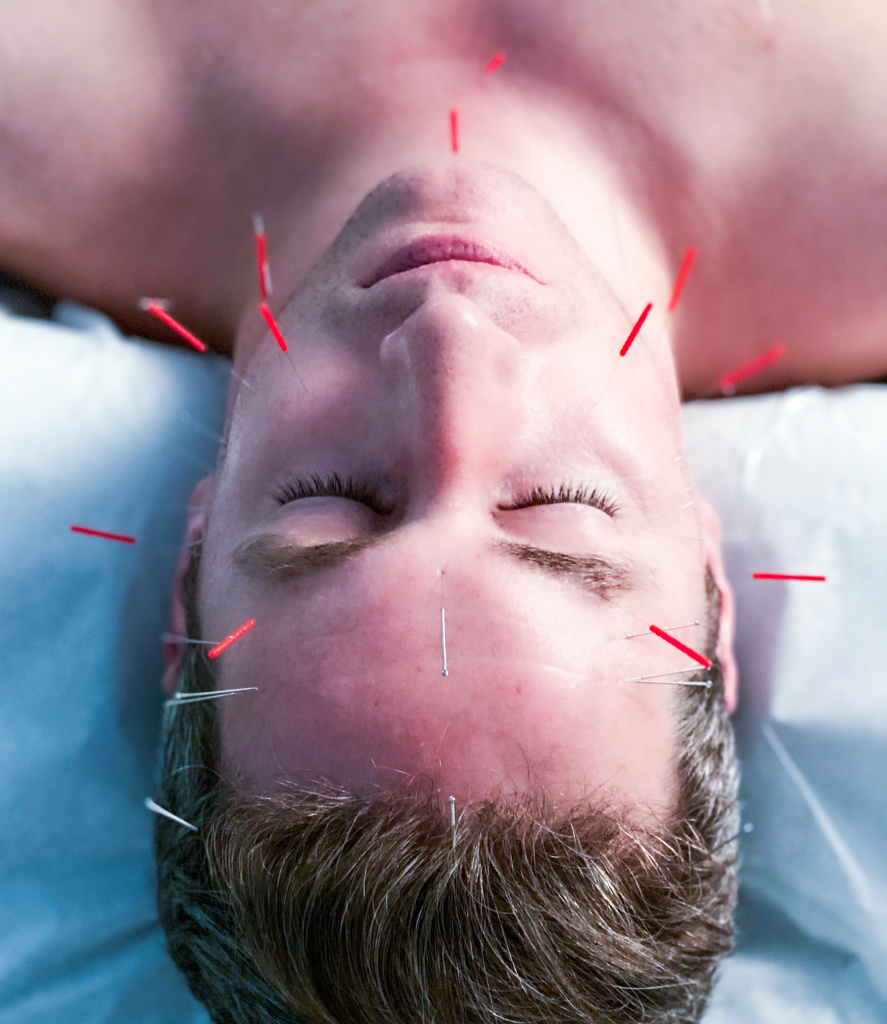 Did you know that #facialacupuncture can make your skin look younger, smoother, and healthier? 
⠀
Facial acupuncture helps to stimulate collagen production and improve circulation, resulting in the reduction of fine lines and wrinkles. 🙋‍♀️🙋‍♂️#acupuncturist #nychealth