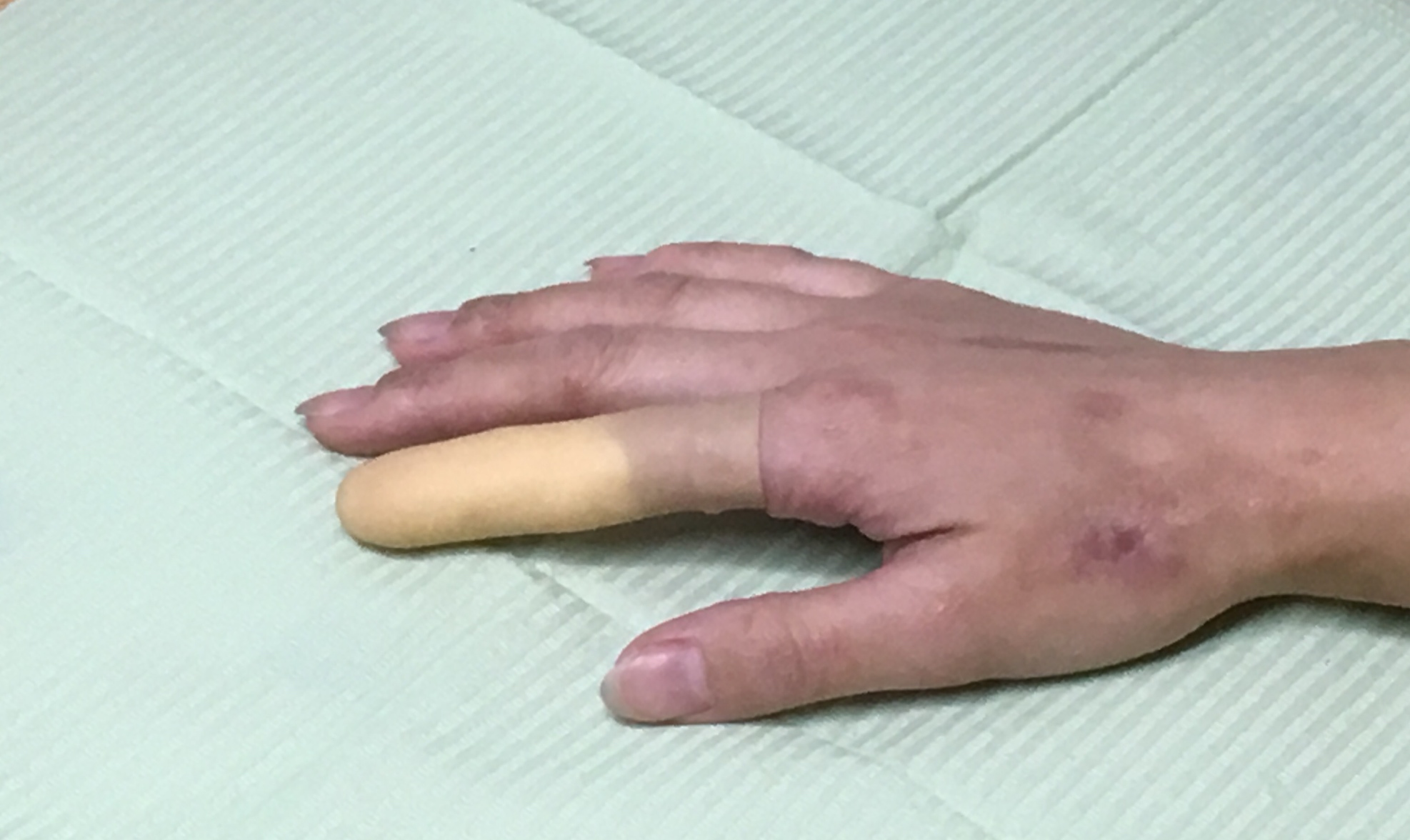 義指、エピテーゼ指、女性用人差し指 義指、エピテーゼ指、女性用人差し指
