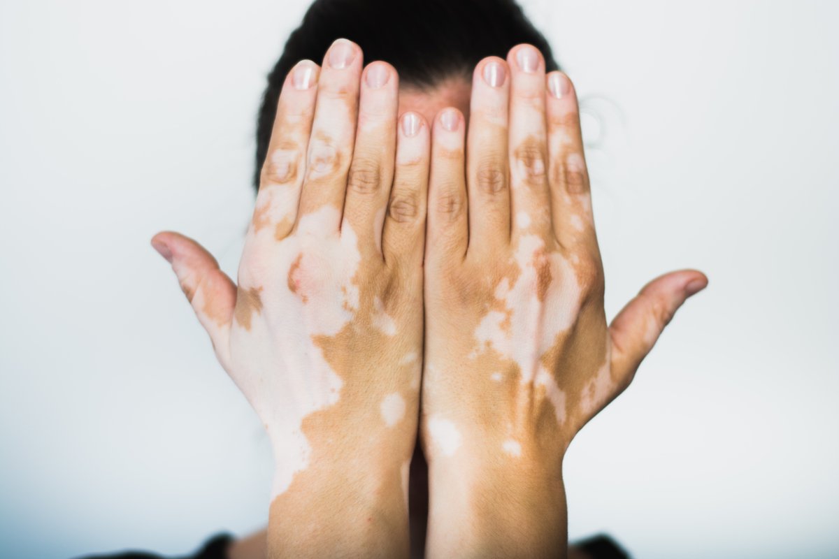 CIESAS Peninsular (@ciesaspeninsula) on Twitter photo Vitiligo, una patología sin cura y con muchas preguntas por resolver dlvr.it/RQgDVB <a href="/amciencias/">Academia Mexicana de Ciencias</a> Vitiligo, una patología sin cura y con muchas preguntas por resolver dlvr.it/RQgDVB <a href="/amciencias/">Academia Mexicana de Ciencias</a>