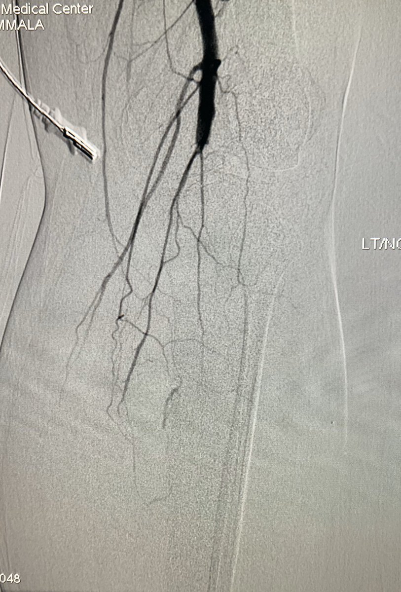 t_intheleadcoat's tweet photo. #paradoxicalembolus leading to #coldleg ( day2)a #submassivePE ( day1) undergoing #CDT. Fortunately #leg and #lung #clots resolved with CDT. Underwent elective large #PFO/ #ASD closure subsequently. #irad @SIRspecialists @SIR_ECS #TwittIR @PERTConsortium @JVIRmedia #thrombectomy https://t.co/fFyFwzgomI