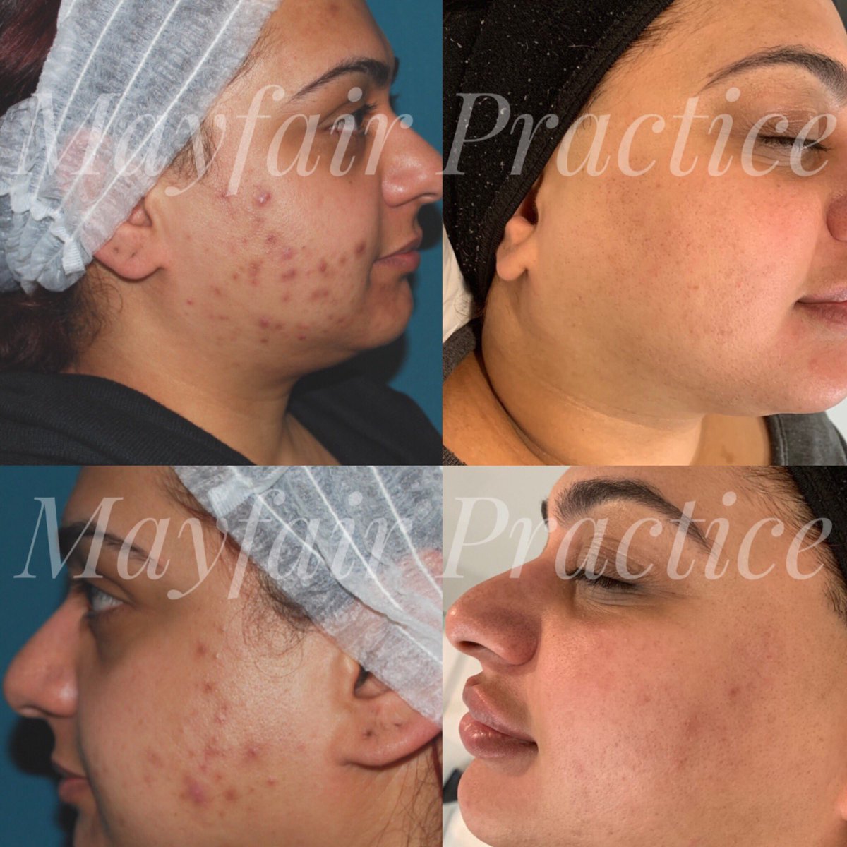 You might not believe us when we tell you that Chandli can work serious magic with skin ✨ We’ll let the pictures do the talking. If you’ve got any skin concerns, make sure to book your consultation with Chan 🤩 mayfairpractice.co.uk