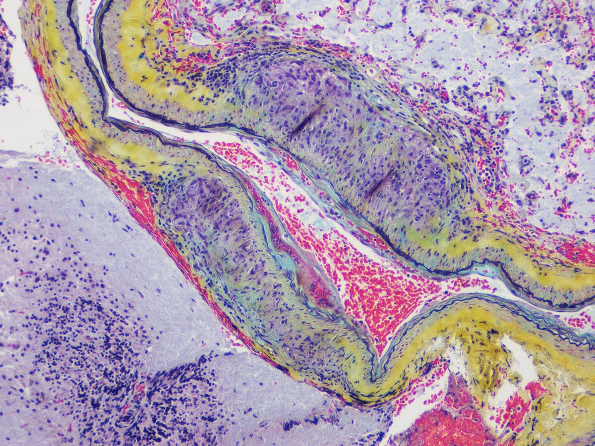 Non-caseating granulomatous vasculitis, differential includes PACNS and Neurosarcoidosis (amyloid and bug stains were negative and no systemic vasculitides identified). #neuropathology #neuropath #pathtwitter