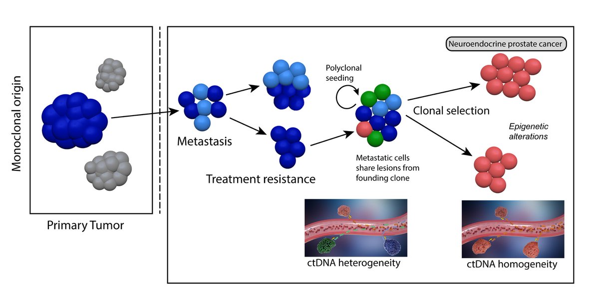 Misha Beltran (@mishabeltran) on Twitter photo Excited about the potential of cfDNA genomics & methylation to understand prostate cancer resistance and identify NEPC. Our new study <a href="/jclinicalinvest/">Journal of Clinical Investigation</a> with <a href="/FrancescaBZNY/">Francesca Demichelis</a> and many great collaborators <a href="/aromanel/">Alessandro Romanel</a> <a href="/DrScottTagawa/">Scott Tagawa</a> and many more <a href="/PCF_Science/">PCF Science</a> jci.org/articles/view/… Excited about the potential of cfDNA genomics & methylation to understand prostate cancer resistance and identify NEPC. Our new study <a href="/jclinicalinvest/">Journal of Clinical Investigation</a> with <a href="/FrancescaBZNY/">Francesca Demichelis</a> and many great collaborators <a href="/aromanel/">Alessandro Romanel</a> <a href="/DrScottTagawa/">Scott Tagawa</a> and many more <a href="/PCF_Science/">PCF Science</a> jci.org/articles/view/…