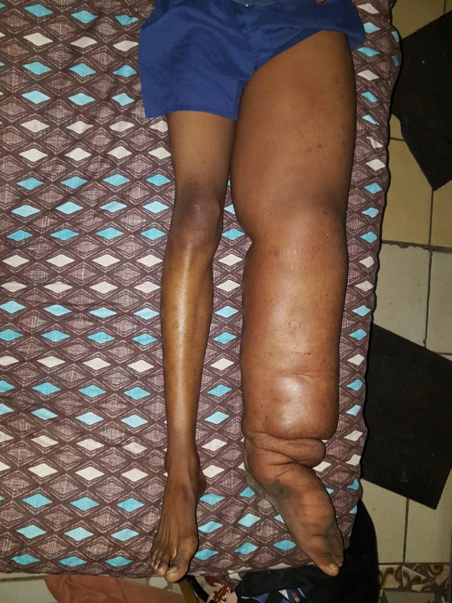 Gemini_Papi_'s tweet photo. Good morning.
You can only understand someone/their pain if you feel them in yourself. Could we please help our brother, a son, a father get treatment for Lymphedema by donating using the link below 🙏🏽 https://t.co/Nt1Ae69VDe https://t.co/kqIzKraFvd