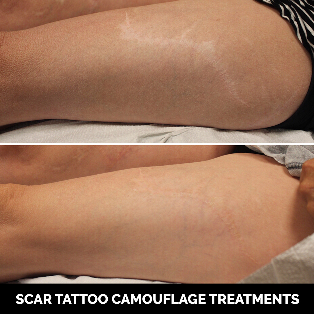 Can scars be camouflaged with skin tone tattoo ink  Ink Illusions