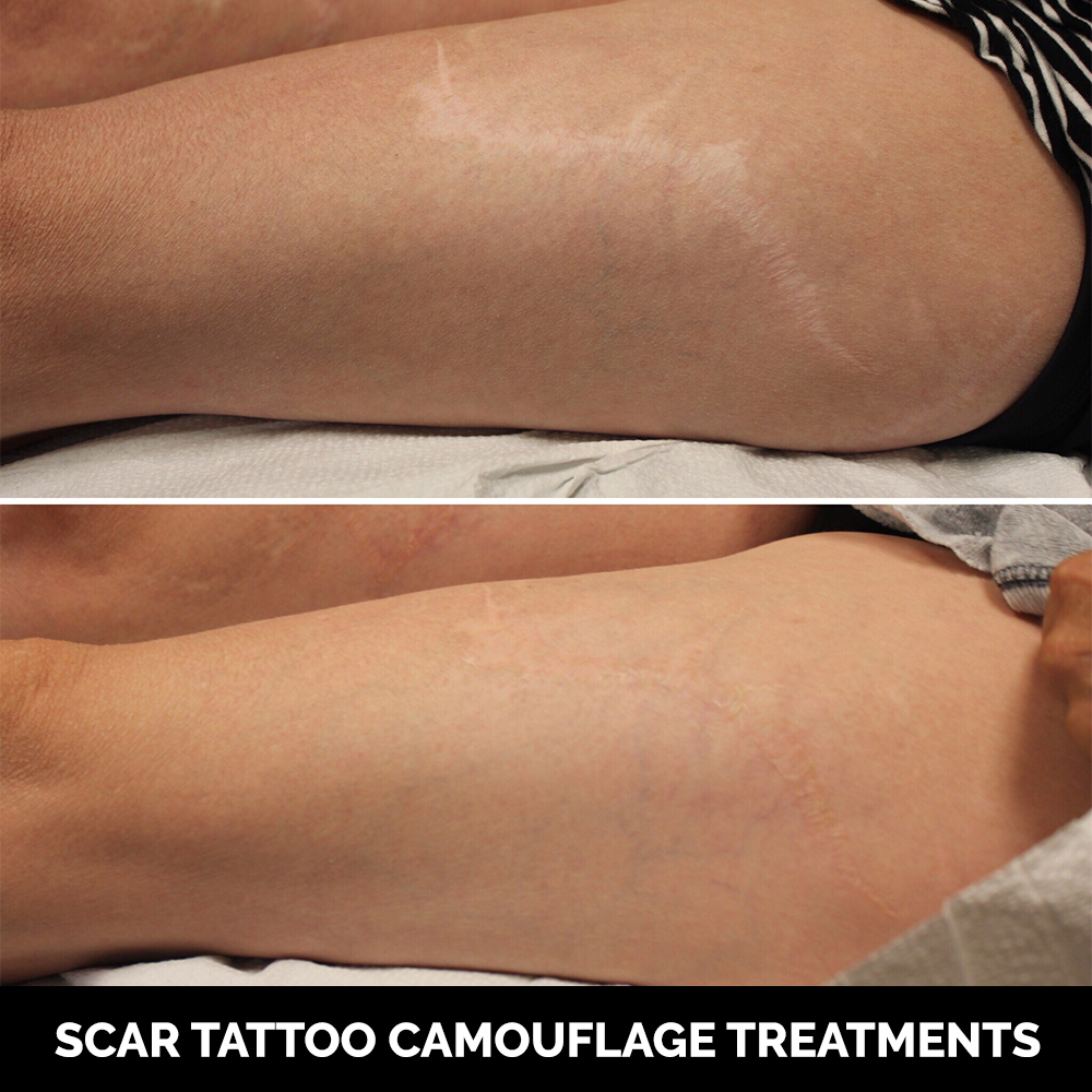 St Petersburg Scar Camouflage Tattooing on Tanned Skin #8 St Petersburg Scar Camouflage Tattooing on Tanned Skin