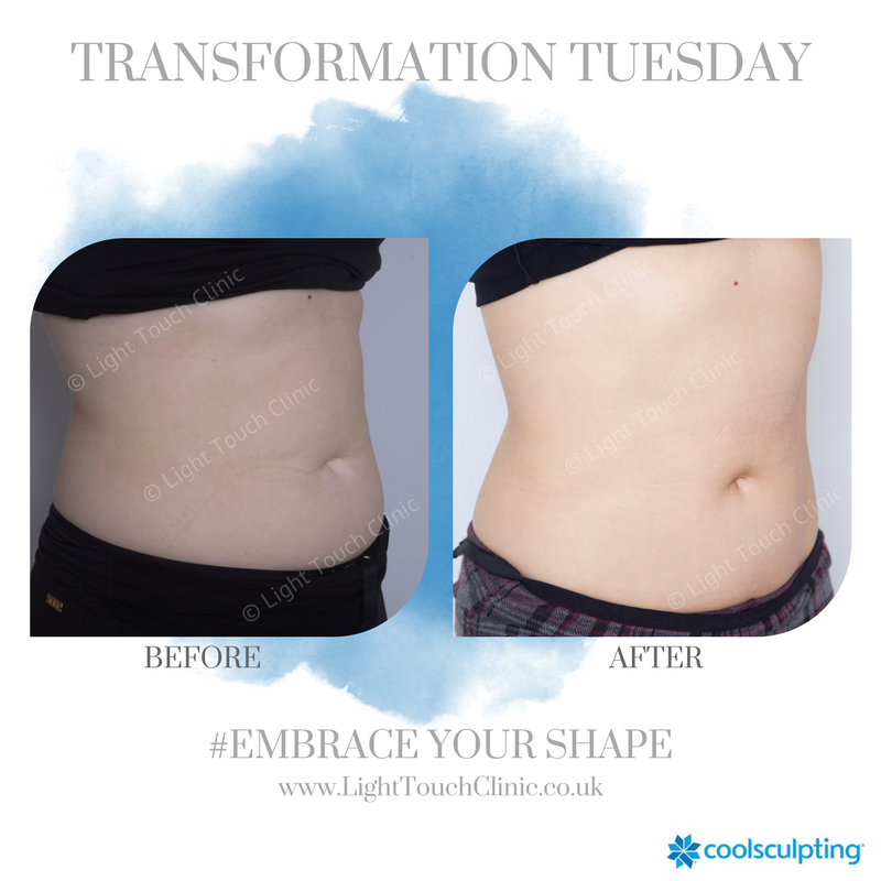 lightouchclinic's tweet photo. Eliminate stubborn fat with CoolSculpting❄️ We can specifically target those hard to get rid of areas with our specialist applicators.

To book a consultation and see what CoolSculpting can do for you, get in touch!

📞- 01932 849552
✉️- info@lighttouchclinic.co.uk https://t.co/TsCtxr84rq