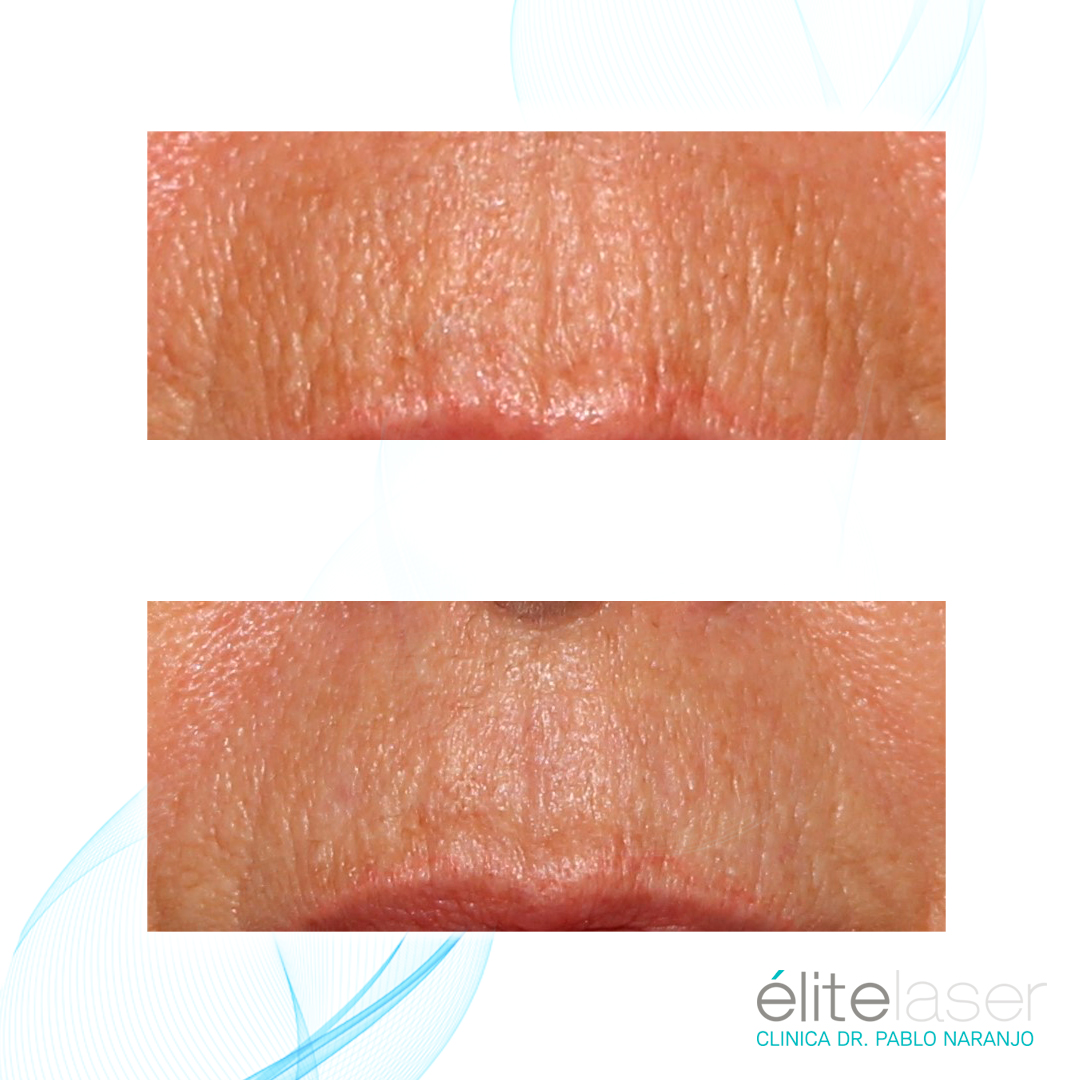 clinielitelaser's tweet photo. Antes y después de un tratamiento  de rejuvenecimiento peribucal.

#rejuvenecimientofacial #clinicaelitelaser #drpablonaranjo https://t.co/tRRQ9vz1qu