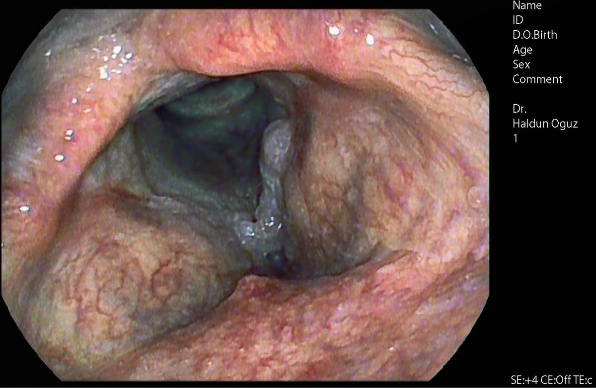 HaldunOguz's tweet photo. Günün Olgusu - Laringeal (Glottik) Papillomatozis: 
Chip-on-Tip Fleksibl Endoskopik i-scan Görüntüsü.
.
.
.
.
#papillomatosis #sestelikanseri #sestelipolibi #sestelinodülü
#sesameliyatı #sesdoktoru #sescerrahisi #sestedavisi #sesterapisi https://t.co/M6vL4mVWFN