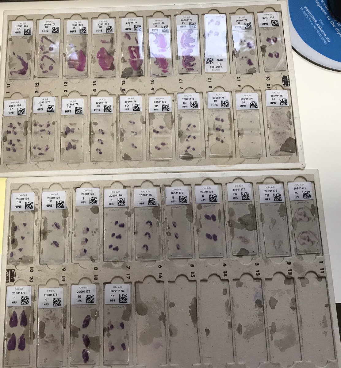 Sometimes I love my job, sometimes I receive a post-chemotherapy gastrectomy with poorly cohesive carcinoma, and so much, so much (benign?) lymph nodes with sinusoïdal macrophages to complicate things further. Do you perform  cytokeratin on all the blocks if negative?