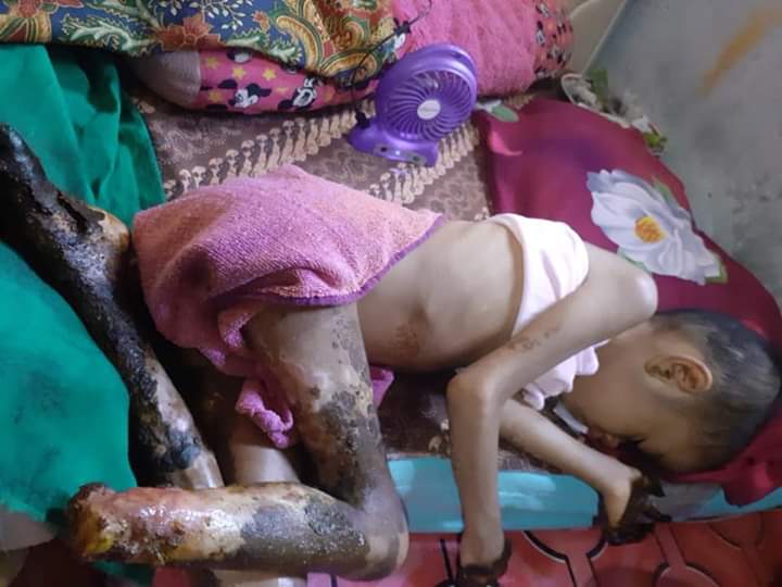 Ini adek yang kita jenguk tadi Namanya winda, usia 7 tahun
Sudah 8 bulan lebih dia selalu menangis dan kesakitan, dikarenakan terkendala biaya. Ayahnya hanya seorang tukang becak sementara ibu hanya pedagang keliling. Mari kita bantu adik winda agar dia bisa sembuh👇