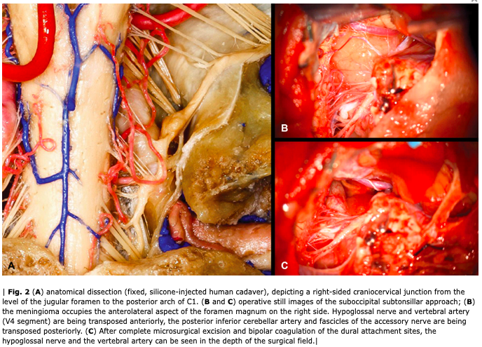 NASBS (@nasbsorg) on Twitter photo #nsgy #OpVid from #Germany and <a href="/PittNeurosurg/">Pitt Neurosurgery</a> demonstrating the Midline Suboccipital Subtonsillar Approach with C1 Laminectomy for Resection of Foramen Magnum #meningioma #neuroonc #education #neurosurgery #approaches thieme-connect.com/products/ejour… #nsgy #OpVid from #Germany and <a href="/PittNeurosurg/">Pitt Neurosurgery</a> demonstrating the Midline Suboccipital Subtonsillar Approach with C1 Laminectomy for Resection of Foramen Magnum #meningioma #neuroonc #education #neurosurgery #approaches thieme-connect.com/products/ejour…