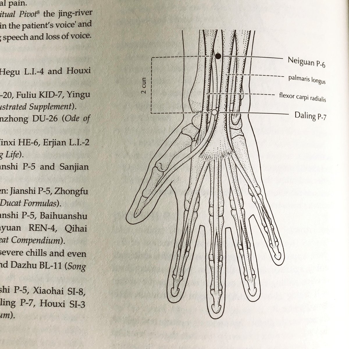 PinCushionSea's tweet photo. Pericardium 6 is an excellent point for acid reflux or GERD. P-6, also known as NEIGUAN, is used to calm anxiety, relax the chest, and prevent rebellious energy from rising up into the esophagus. #acupuncture #communityacupuncture #gerd #acidreflux #pericardium #neiguan #seattle https://t.co/yEyqIFVk9j