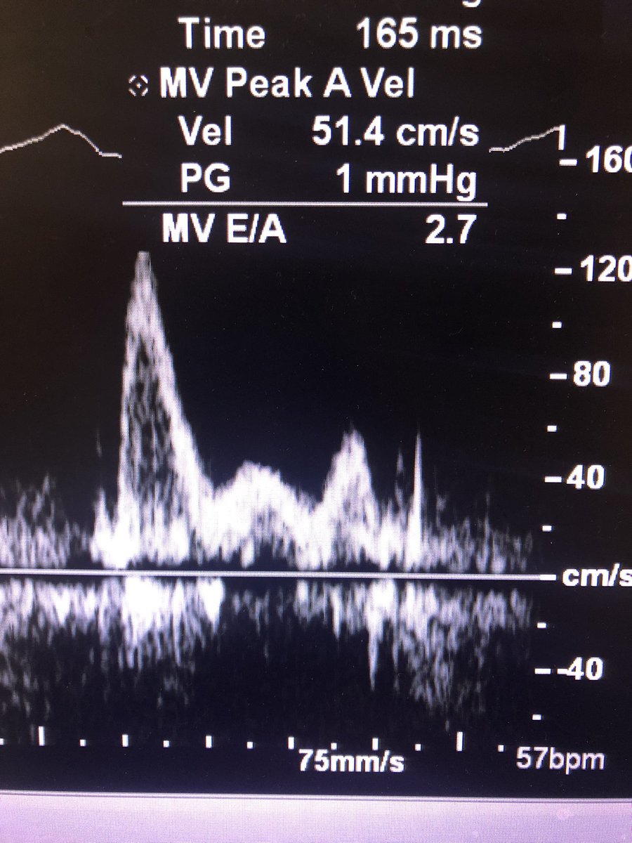 Andrew Putnam MD (@andrew_putnam87) on Twitter photo What’s the interesting finding? (At least to me!) And what does it mean? <a href="/UCCardsFellows/">University of Chicago Cardiology Fellowship</a> <a href="/robertomlang/">Roberto M Lang</a> <a href="/PWard35/">Parker Ward</a> <a href="/AkhilNarangMD/">Akhil Narang, MD</a> <a href="/KalieKebed/">Kalie Kebed MD</a> What’s the interesting finding? (At least to me!) And what does it mean? <a href="/UCCardsFellows/">University of Chicago Cardiology Fellowship</a> <a href="/robertomlang/">Roberto M Lang</a> <a href="/PWard35/">Parker Ward</a> <a href="/AkhilNarangMD/">Akhil Narang, MD</a> <a href="/KalieKebed/">Kalie Kebed MD</a>