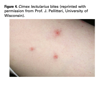 AfAfter's tweet photo. @Airbnb @AirbnbHelp @AirbnbCitizen @airbnb We had a bed bug case in Paris and the refund claim was not dealt. Today I went through all academic journal articles I could find about bed bug, This this my mother's right leg compared to doctor's advise for diagnosis. https://t.co/tYCcn5lNih