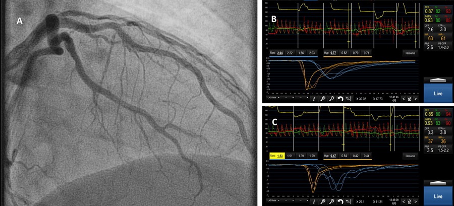 Bill Little (@billrlittle) on Twitter photo 5 admissions in a little over a year, then he got a Reducer.
Coronary sinus reducer for microvascular angina via <a href="/PCRonline/">PCRonline 🫀</a> pcronline.com/tiny/url/472117
<a href="/ziadalinyc/">Ziad Ali</a> <a href="/ESHLOF/">Evan Shlofmitz</a> <a href="/allenj/">jusTin</a> <a href="/GreggWStone/">Gregg W. Stone MD</a> <a href="/HenrytTimothy/">Timothy Henry</a> <a href="/JEscaned/">Javier Escaned</a> @ajaykirtane <a href="/SVRaoMD/">Sunil V. Rao</a> <a href="/BillONeillMD/">William W. O'Neill</a> 5 admissions in a little over a year, then he got a Reducer.
Coronary sinus reducer for microvascular angina via <a href="/PCRonline/">PCRonline 🫀</a> pcronline.com/tiny/url/472117
<a href="/ziadalinyc/">Ziad Ali</a> <a href="/ESHLOF/">Evan Shlofmitz</a> <a href="/allenj/">jusTin</a> <a href="/GreggWStone/">Gregg W. Stone MD</a> <a href="/HenrytTimothy/">Timothy Henry</a> <a href="/JEscaned/">Javier Escaned</a> @ajaykirtane <a href="/SVRaoMD/">Sunil V. Rao</a> <a href="/BillONeillMD/">William W. O'Neill</a>