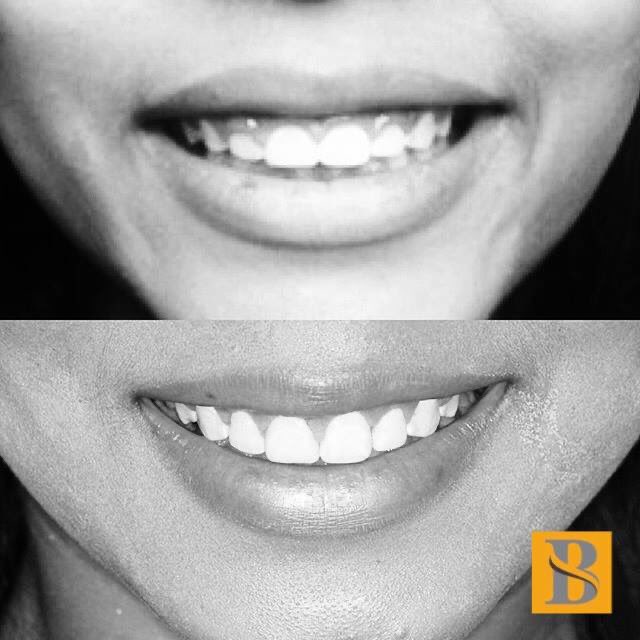 BerksOS's tweet photo. 👀 What an incredible #smiletransformation - the results of a #gingivectomy completed by our own Dr. Winans! This procedure improves gingival health and enhance one’s smile through the removal and reshaping of extra gum tissue. Want to learn more? Contact us at 610-374-4093. https://t.co/4YE1ufiR0T