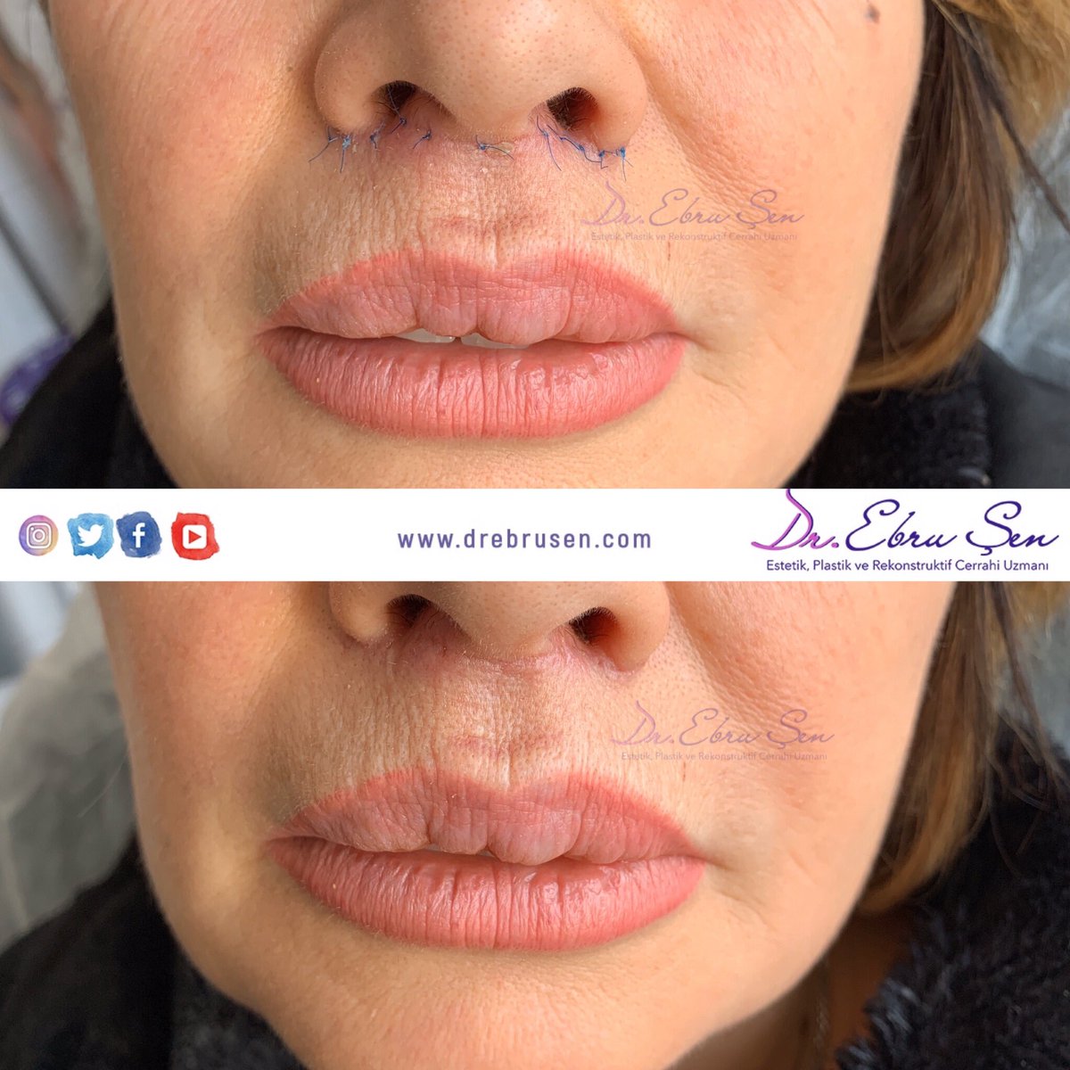 Liplift 1.hafta dikişli ve dikiş alınmış hali Dr. Ebru Şen 🌺 #liplift #drebrusen #doktorebruşen