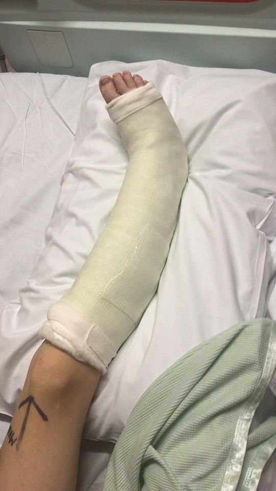 TividaleKarate's tweet photo. Harley update!

Manipulated back into place ✔️
Crutches training in process ✔️
Home last night  🤞🏻
Long road of rehab ahead ✔️

Thank you all for your kind messages and support been very overwhelming I have to say and has certainly kept Harley’s chin up these past 48 hours. https://t.co/MDivCjpgwH