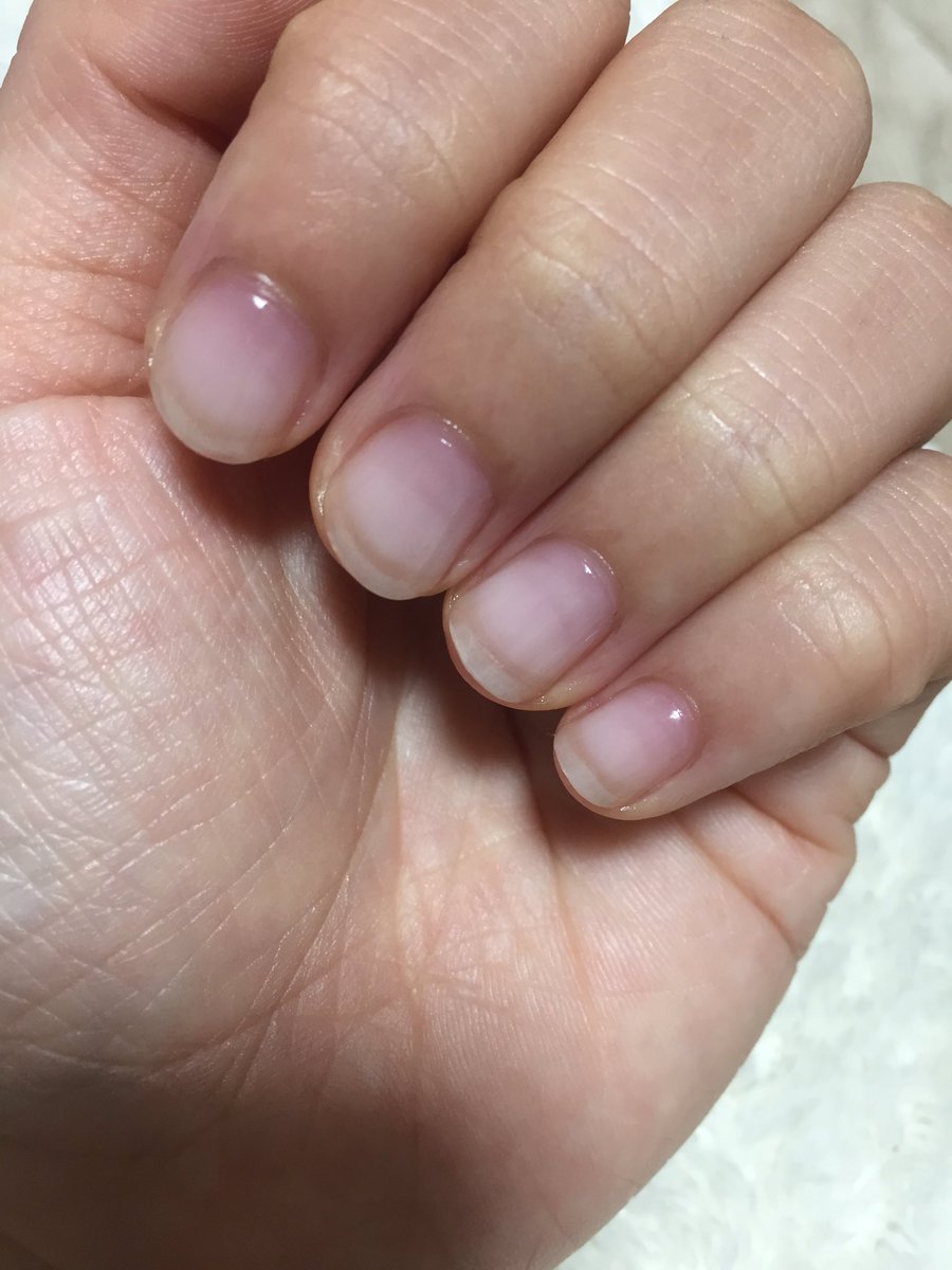 アサナシ 育爪レポート 物心ついた時から深爪でした 爪だけでなく周りの組織も崩してしまっていましたが本気で治して見ようと思って育爪始めました 素爪に優しいパラジェルを使っている深爪 アサナシ 育爪レポート 物心ついた時から深爪でした 爪だけでなく周りの組織も崩してしまっていましたが本気で治して見ようと思って育爪始めました 素爪に優しいパラジェルを使っている深爪