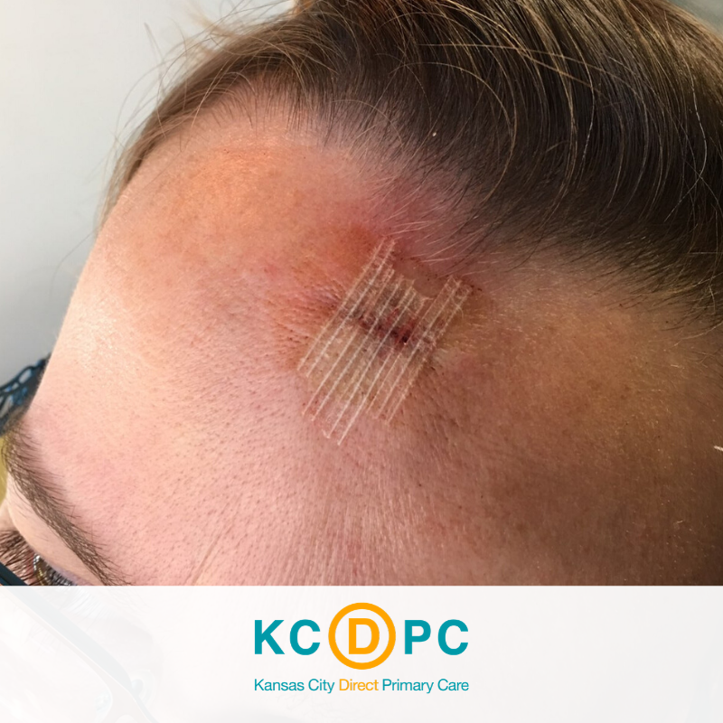 KansasCityDPC's tweet photo. This past holiday season, a patient had a mole that had us all concerned, so she came in to get it removed. The removal and pathology cost $115 and we have a no surprise billing guarantee. How's that for treating people well and caring for their health?
#kansascity
#kcdpc https://t.co/lUDVAgYmoo