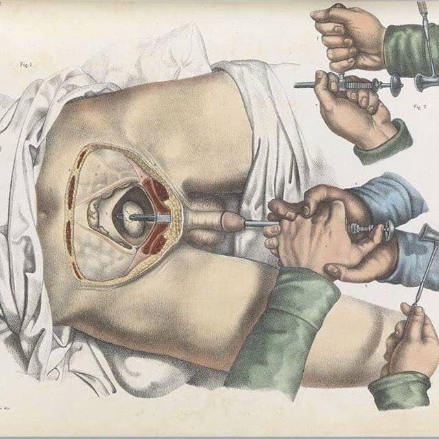 No século XIX, para quebrar uma pedra de sua bexiga, os homens tiveram que passar uma unha através do seu pênis e depois usar um martelo para quebrá-lo em pedaços pequenos o suficiente para passar pela sua uretra.
O litotomia realizado sem anestesia até 1846!😨
