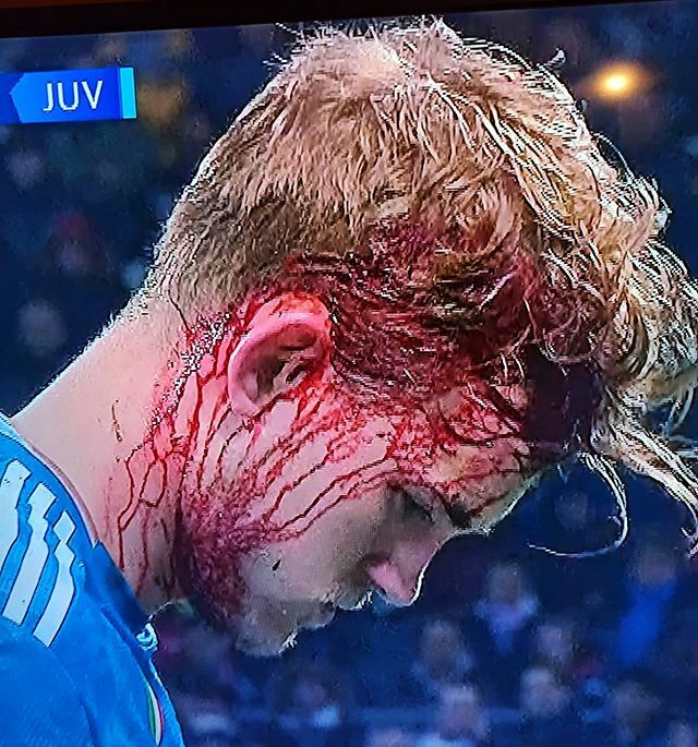 Sekdo's tweet photo. De Ligt leggermente sanguinante! #deligt  #matthijsdeligt #juventus #lionejuve #juventusofficial #juventus_gallery #blood https://t.co/2r4ztedvyZ https://t.co/aG3xA7cO8W