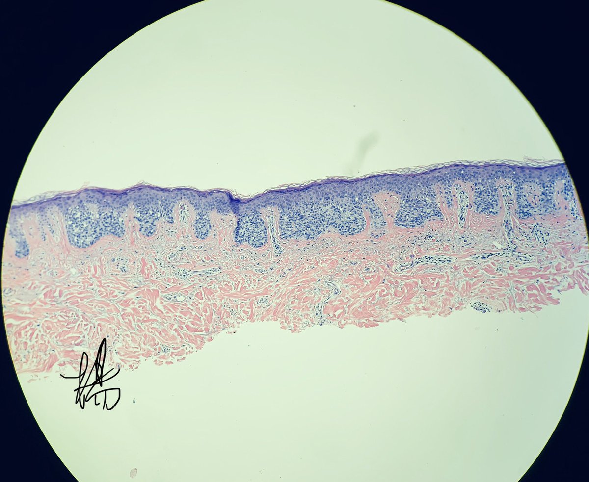 HENRYY_MD's tweet photo. Pigment lesion 4mm, upper back. 65 yo man.  What do You think about ? Melanoma or dysplastic Nevus?@david_terrano @tonitatirado I will show PRAME later.. https://t.co/DKyrV86YFO