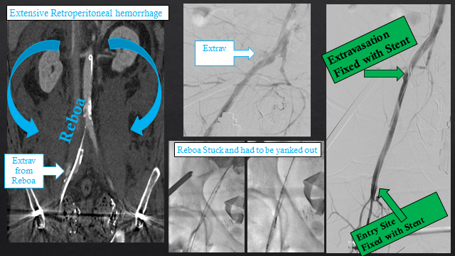 keithppereira's tweet photo. ⚡️#ComprehensiveVascularCare 🌹#WithoutAScalpel ⚡️
Accident💥, Unstable 🏪, systolic 60
Liver lac: Fixed
Shattered Spleen: Fixed
Vessel injury dt REBOA: Fixed
REBOA stuck: Pulled out
MOST Importantly :
Systolic 120
D/C home 6 days later
👇 is Modern Medicine a.k.a. #IRad https://t.co/uyGcATuFLV