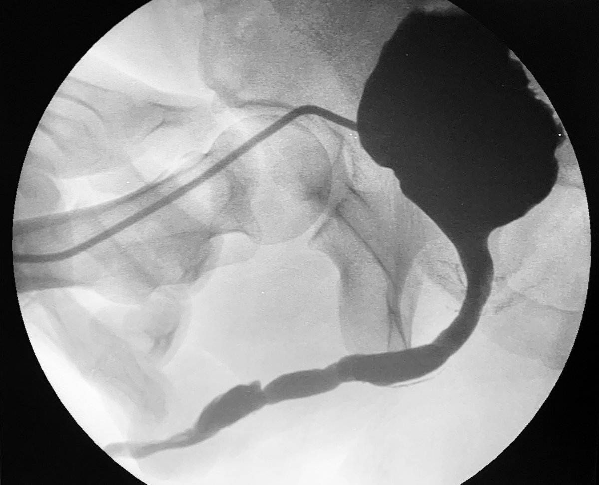 Few urological patients suffer with their disease every day.  42 y/o m. Post ureteroscopic urethral stricture (2 mm stone). Multiple urethrotomies and dilations that probably increased the severity of the scar.  PO 5 weeks ago of penile and bulbar double face BMG urethroplasty.