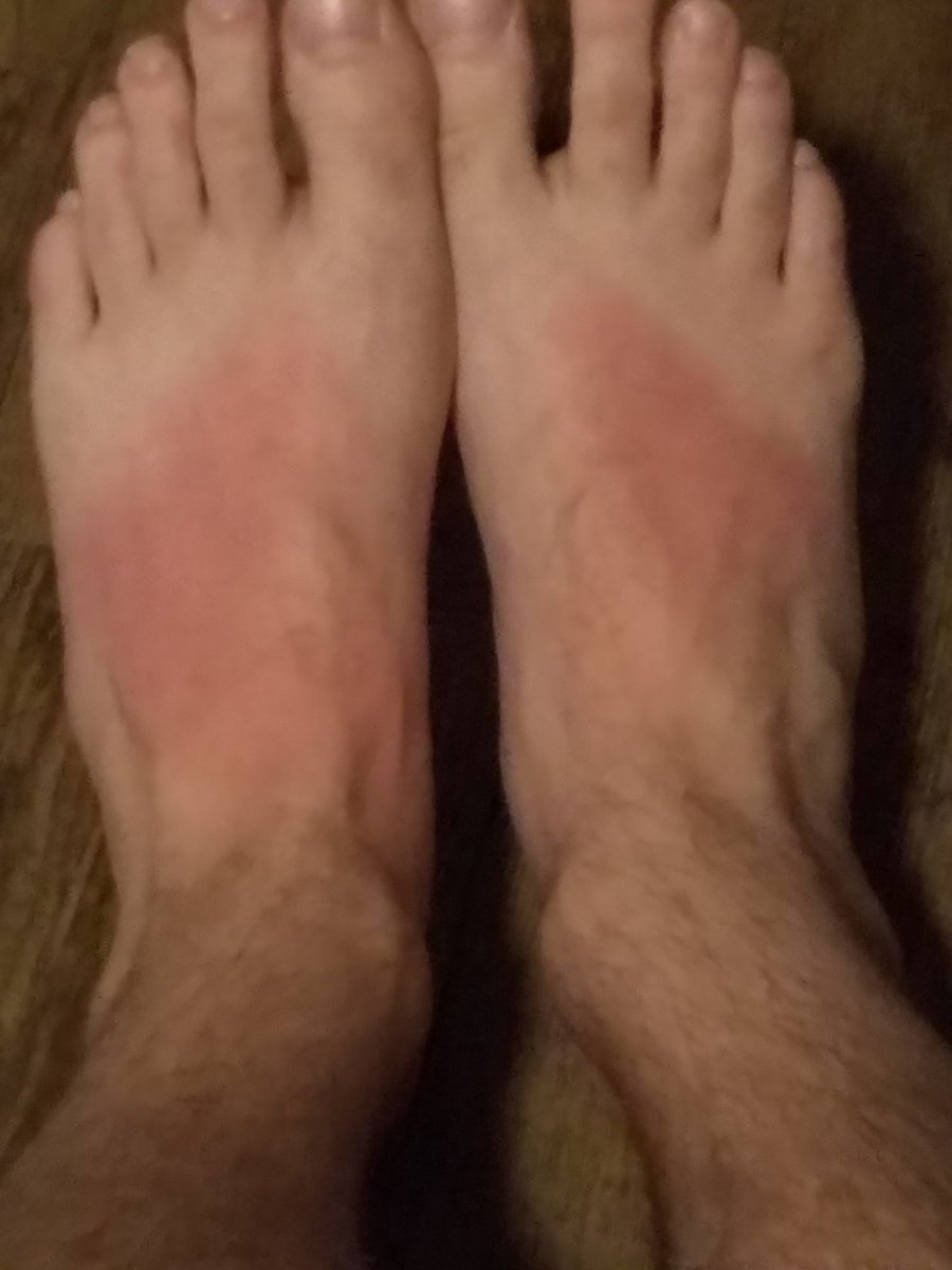 ZackPetersen1's tweet photo. Went on vacation to get tan ended up paler with sunburned feet and sandal tan lines.

*If you want more pics of feet please DM me for prices.

**Don't judge I've got bills https://t.co/qblScTiRxS