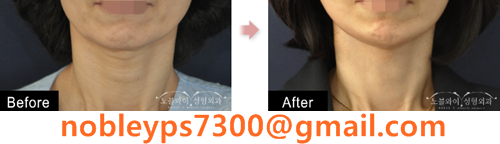 노블와이 성형외과 ノブルワイ美容整形外科 Nobleyps Twitter