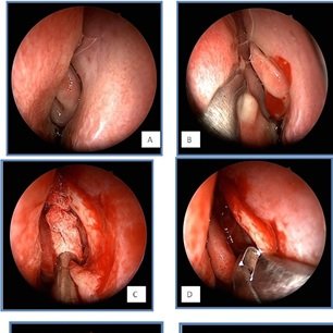 Primary Endonasal #Endoscopic Powered #Dacryocystorhinostomy For Low Obstruction Of The Lacrimal Excretory System In Adult Patients: A 5-Years Experience
heraldopenaccess.us/openaccess/pri…