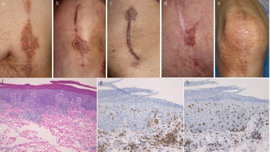 ced_journal's tweet photo. In this study 7 cases of #nummular #eczema on surgical scar sites, which were considered to be induced as a result of #Köbner response, were presented:
https://t.co/Vo13oNjDmj https://t.co/KKc6TseYMK