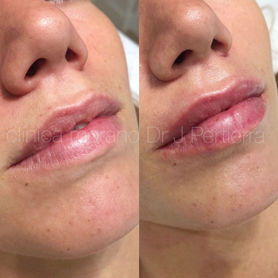 LABIOS DESHIDRATADOS Y PEQUEÑAS IRREGULARIDADES Infiltramos #acidohialuronico para devolver la hidratación al labio a la vez que aportamos un aumento natural de volumen💉Producto Juvederm👩🏻‍⚕️Tratamiento rápido📋No doloroso⏱Incorporación inmediata💡Ligera inflamación #clinicamorano
